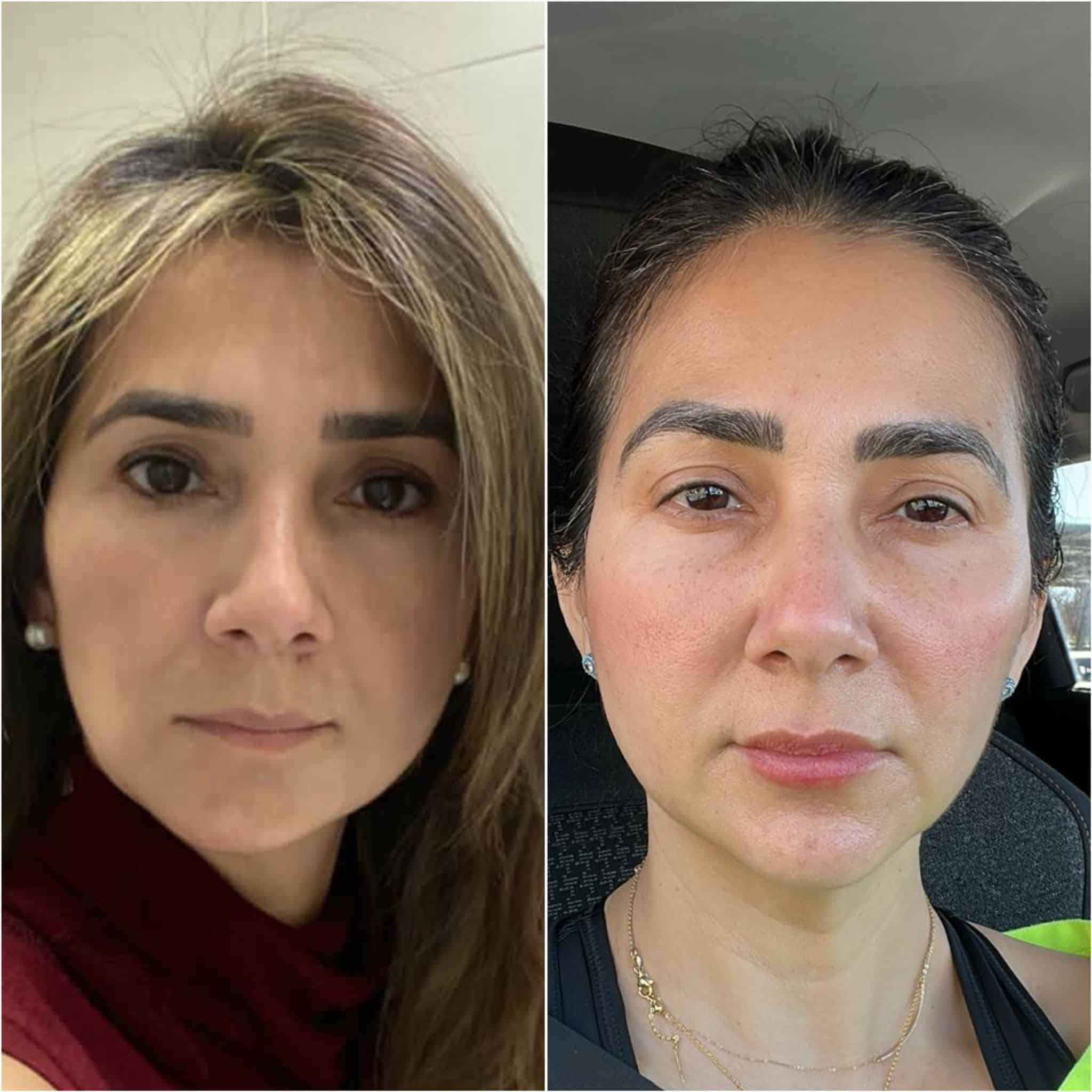 Neuromodulador, pómulos, radiesse y labios