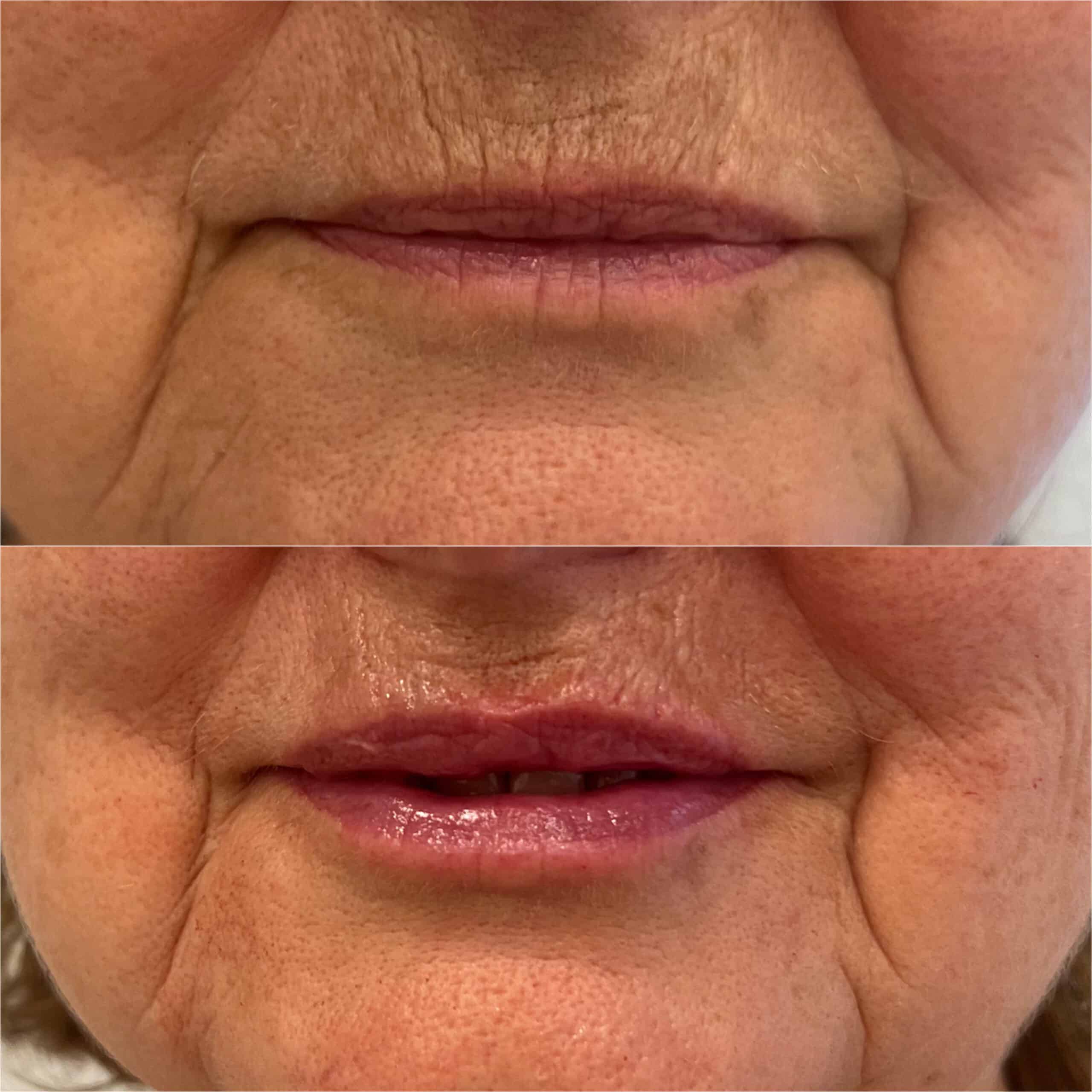 Labios y código barras ácido Hialurónico