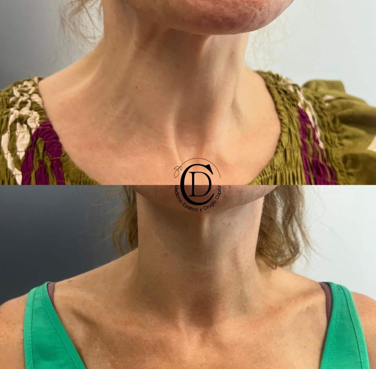 Ácido Hialurónico Cuello