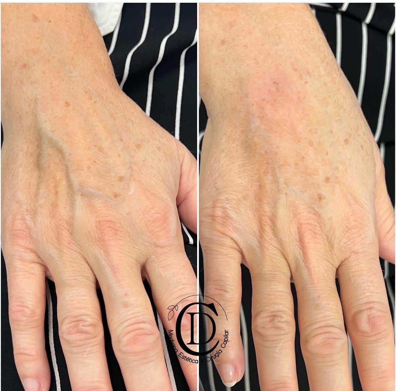 Ácido Hialurónico Manos