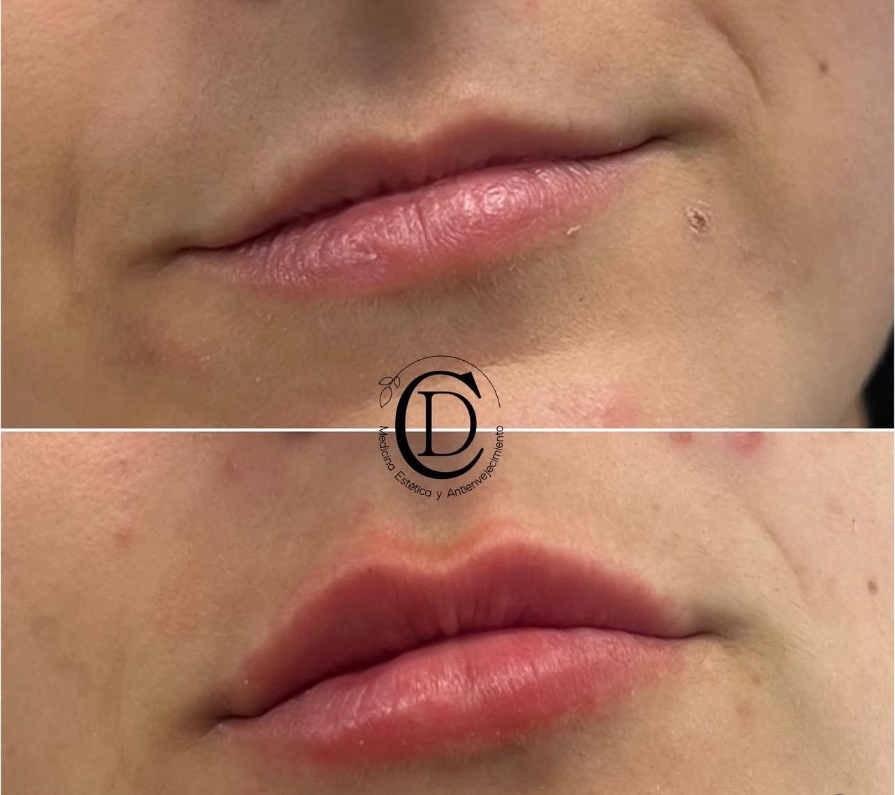 Ácido Hialurónico Labios