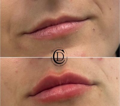 Ácido Hialurónico Labios